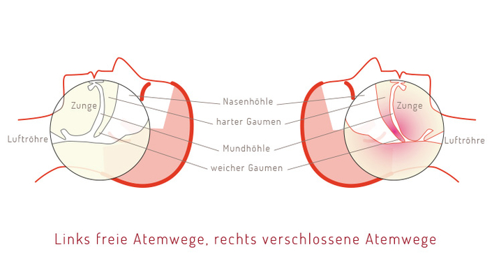 Schlafapnoe